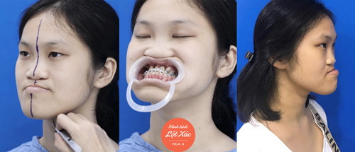 trang nhung hành trình lột xác 