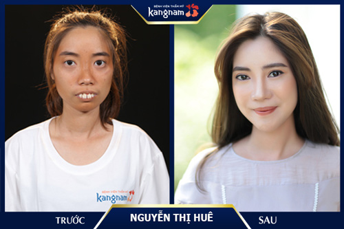 Huê trước và sau khi phẫu thuật