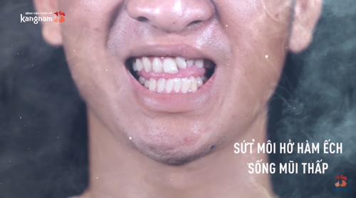 sứt môi hở hàm ếch
