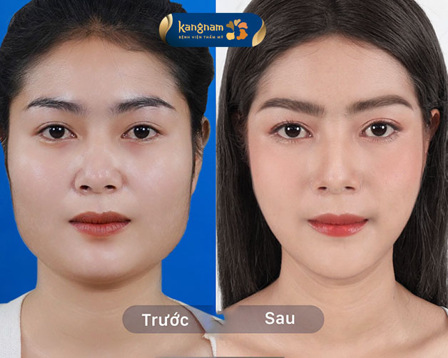 Cân chỉnh hàm vuông, bạnh bằng công nghệ cao
