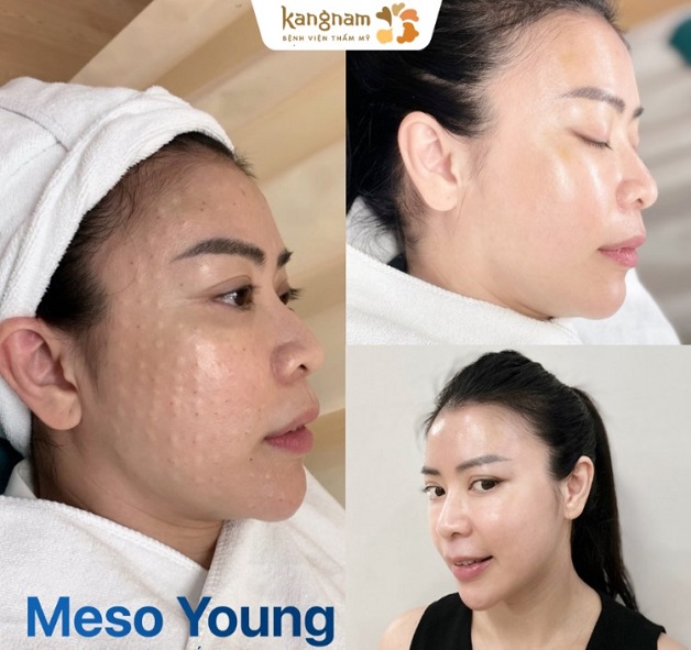 Trẻ hóa da bằng tiêm meso