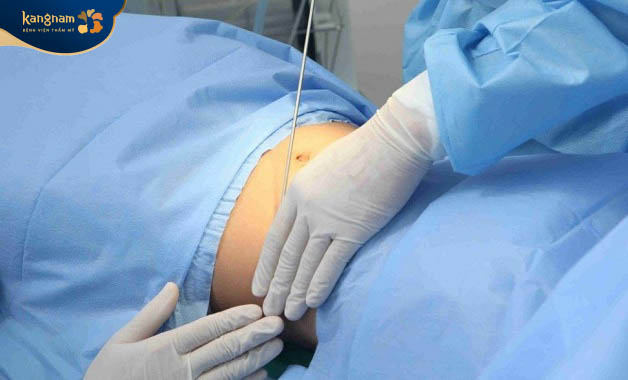 Phương pháp hút mỡ bụng giúp loại bỏ mỡ thừa cứng đầu nhanh chóng