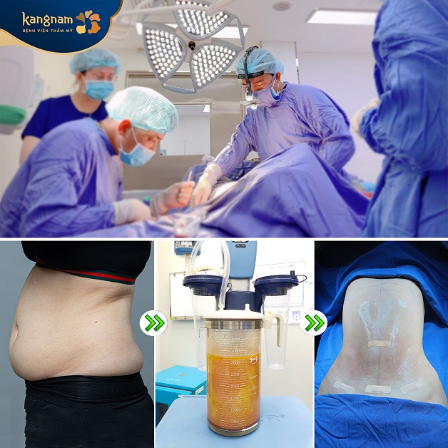 Giảm mỡ bụng bằng công nghệ Lipo 360 hiện đại nhất hiện nay