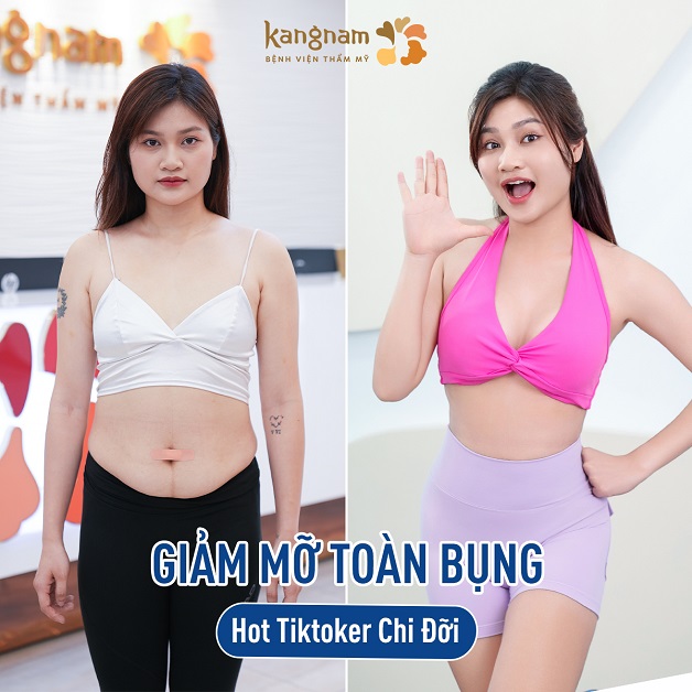 Hot tiktoker Chi Đỡi sở hữu vòng 2 thon gọn, thời gian phục hồi nhanh chóng sau khi hút mỡ bụng