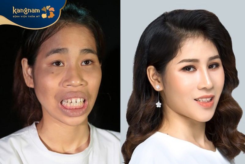 Cao Thị Lan thay đổi ngoạn mục sau HTLX