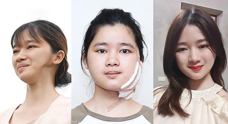 Cô gái mặt lõm Thu Hường và hành trình thay đổi ngoạn mục