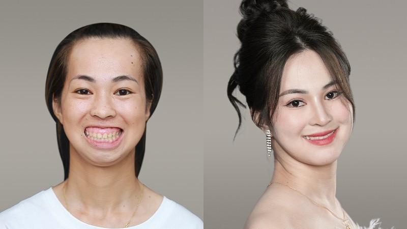 Nguyễn Kim Phượng thí sinh Hành Trình Lột Xác được phẫu thuật chỉnh hàm miễn phí