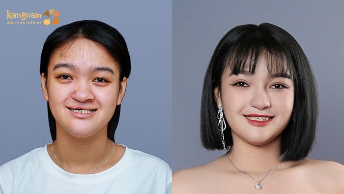 Bùi Như Cảnh sau khi được phẫu thuật chỉnh hàm ếch