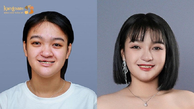 Sau khi trưởng thành có thể thực hiện chỉnh hình để đảm bảo tính thẩm mỹ