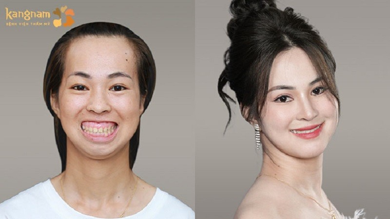 Hành trình Lột Xác giúp Nguyễn Kim Phượng được phẫu thuật chỉnh hàm miễn phí