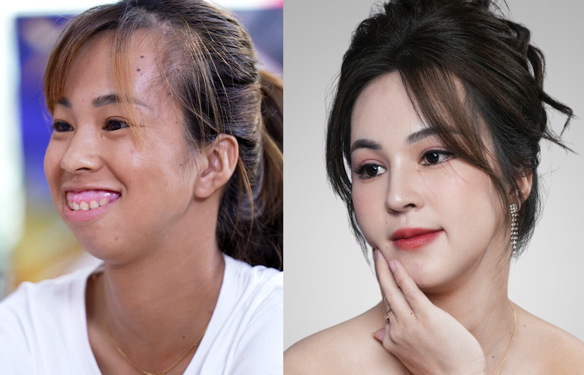 Kim Phượng sở hữu nhan sắc đỉnh cao sau khi chỉnh hàm