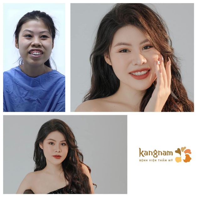 Sở hữu nhan sắc xinh đẹp sau khi chữa cười hở lợi
