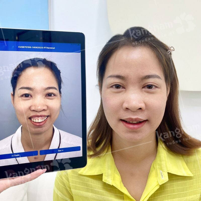 Mức độ hở lợi ảnh hưởng đến chi phí chữa cười hở lợi