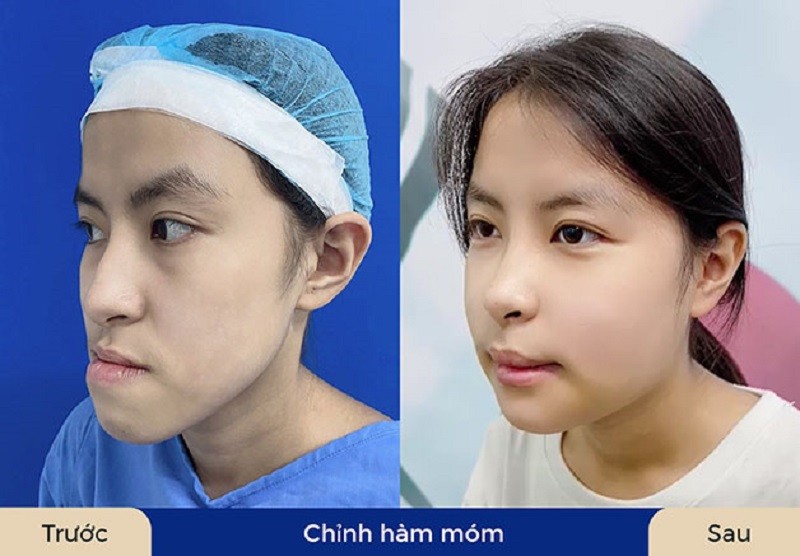 Chi phí phẫu thuật hàm hô móm trên thị trường rất đa dạng