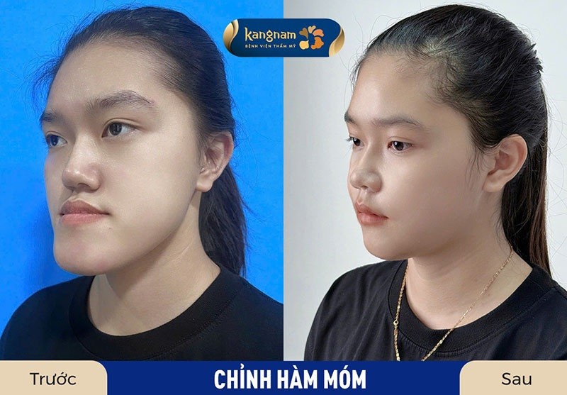 Phẫu thuật hàm móm được áp dụng với những trường hợp móm nặng
