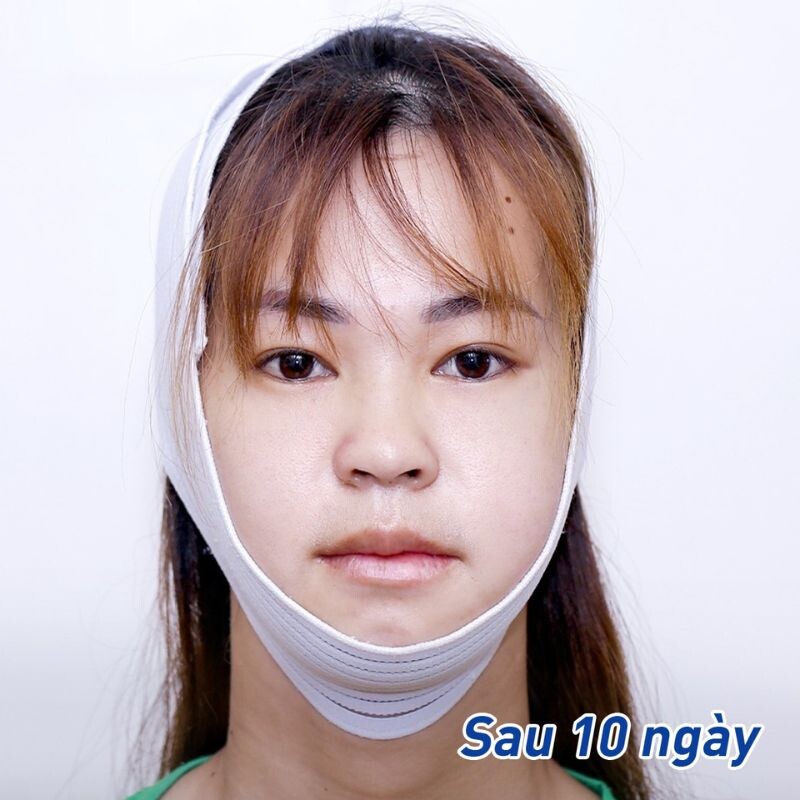 Sưng sau phẫu thuật là bình thường