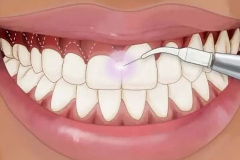 Cắt lợi bằng laser không phẫu thuật