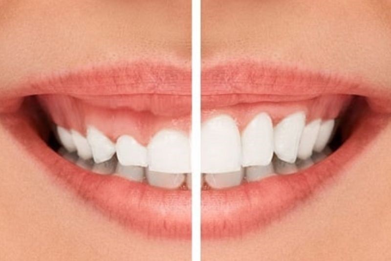 Có nhiều phương pháp chữa cười hở lợi không phẫu thuật