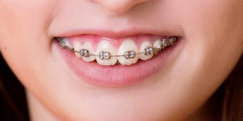 Niềng răng có thể khắc phục cười hở lợi