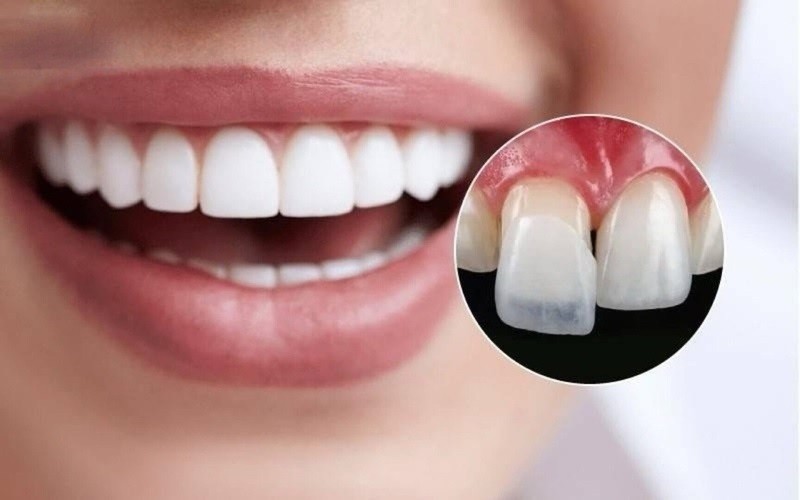 Trông răng sứ giảm thiểu lộ nướu