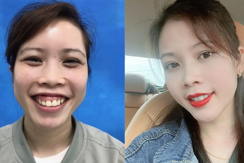 Chọn cơ sở thẩm mỹ hoặc nha khoa cung cấp đa dạng các dịch vụ điều trị cười hở lợi