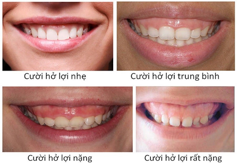 Tùy vào từ cấp độ, sẽ có phương pháp điều trị phù hợp