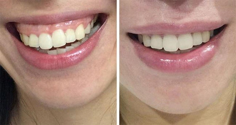 Những người gặp tình trạng cười hở lợi nên đi thăm khám
