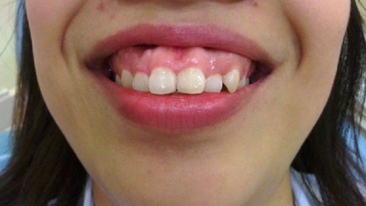 Cười hở lợi nặng là gì? Điều trị bằng phương pháp nào?