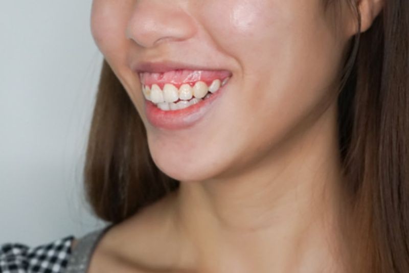 Con gái cười hở lợi bị xem là kém duyên
