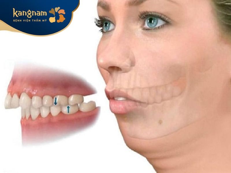 Xương hàm trên phát triển quá mức gây ra tình trạng cười hở lợi
