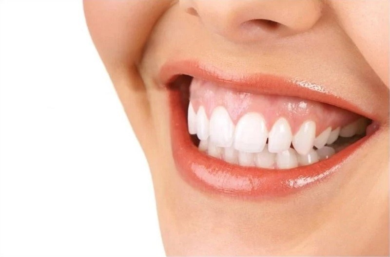 Cười hở lợi là tình trạng lộ nướu khi cười