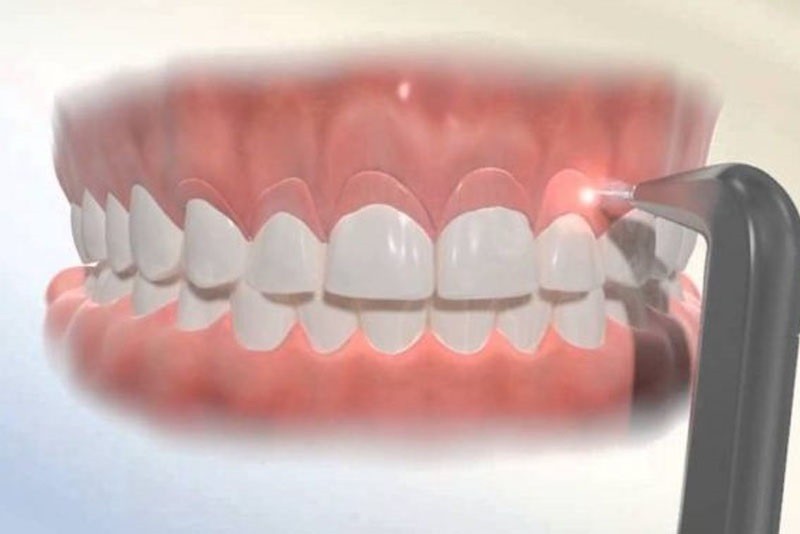 Cắt nướu cũng chữa tình trạng cười hở lợi