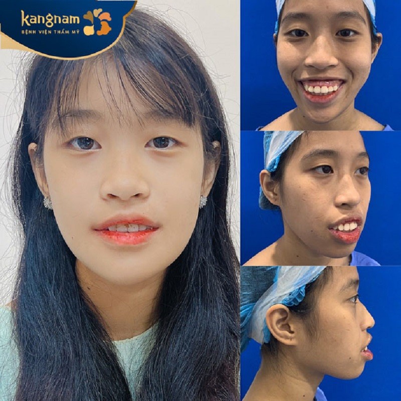Những người bị cười hở lợi có thể điều trị được