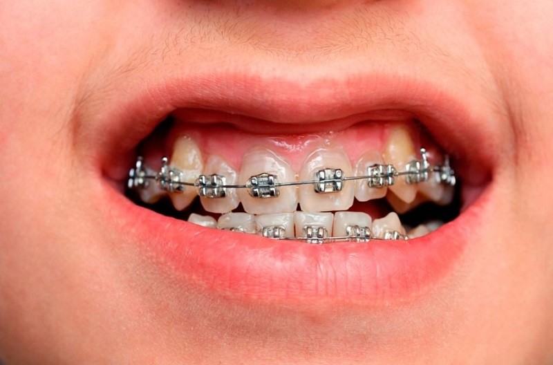 Niềng răng được chỉ định với những trường hợp răng hô