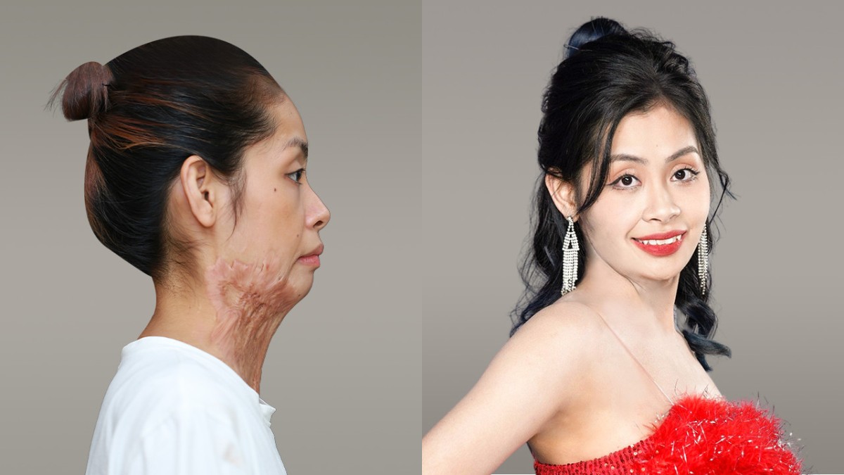 Thí sinh mùa 6 với vết sẹo bỏng dài được tái tạo toàn diện