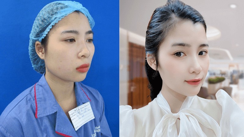 Trượt cằm hồi phục cơ bản sau 1-2 tuần