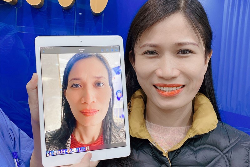 Độn thái dương không đau vì sẽ được gây tê