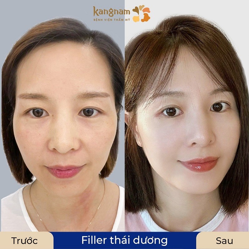 Tiêm filler thái dương không sưng đau quá lâu nhưng kết quả không được lâu dài