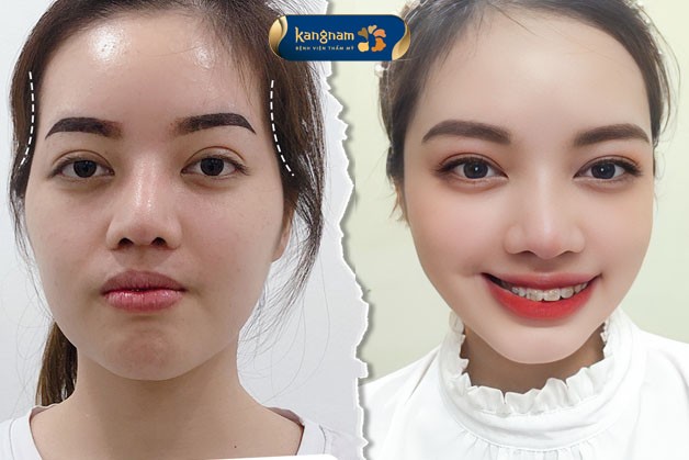 Kết quả sau độn thái dương: gương mặt cân đối, trẻ trung
