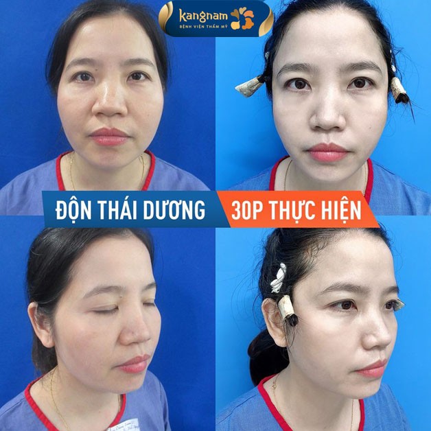 Chi phí độn thái dương tùy thuộc vào chất liệu độn, tay nghề bác sĩ và cơ sở thực hiện