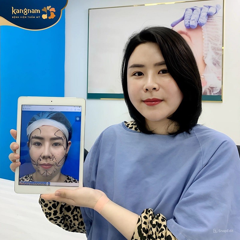 Cấy mỡ tự thân làm đầy thái dương hóp