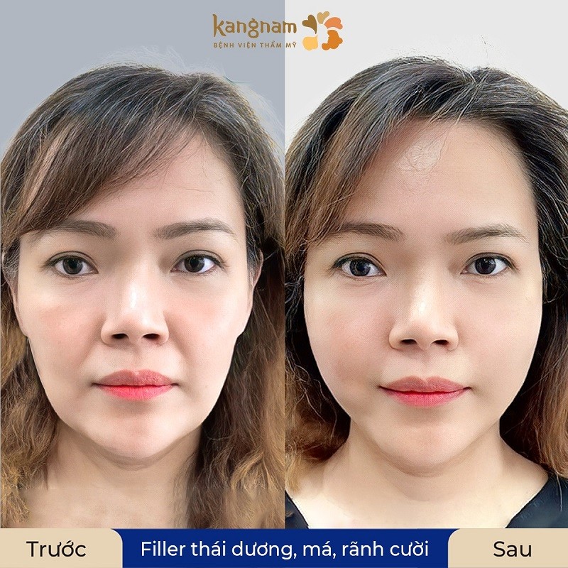Tiêm filler làm đầy thái dương hiệu quả nhanh, không mất nhiều thời gian nghỉ dưỡng nhưng không duy trì được vĩnh viễn