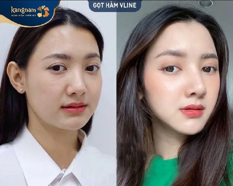 Chi phí gọt hàm trên thị trường khá đa dạng