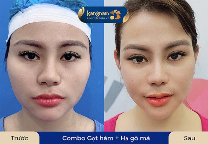 Khách hàng thực hiện combo gọt hàm và hạ gò má