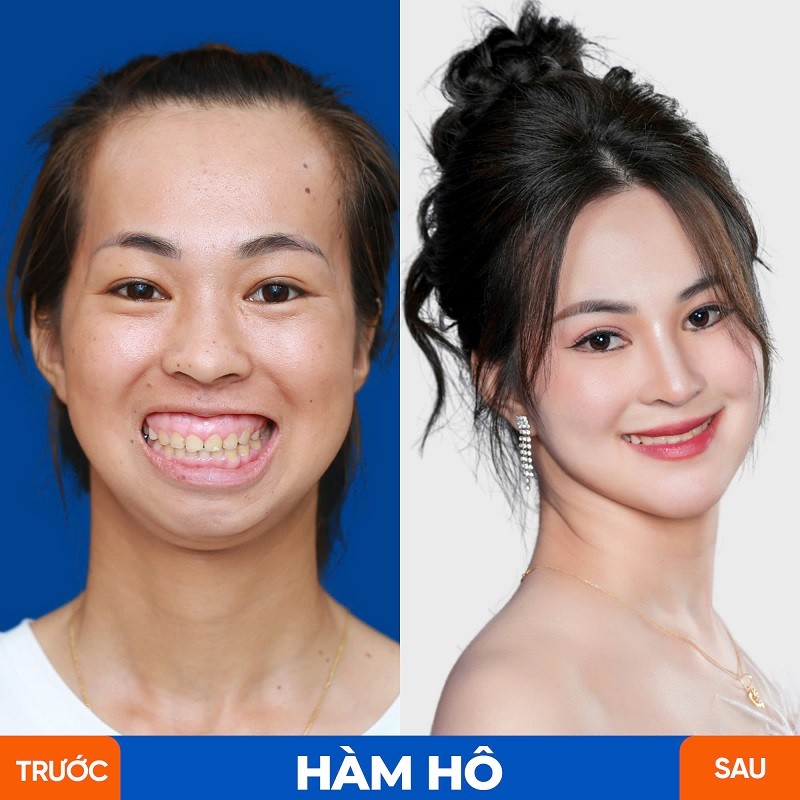 Chương trình Hành Trình Lột Xác giúp các thí sinh cải thiện tình trạng hàm hô, góc hàm to bạnh hoàn toàn miễn phí
