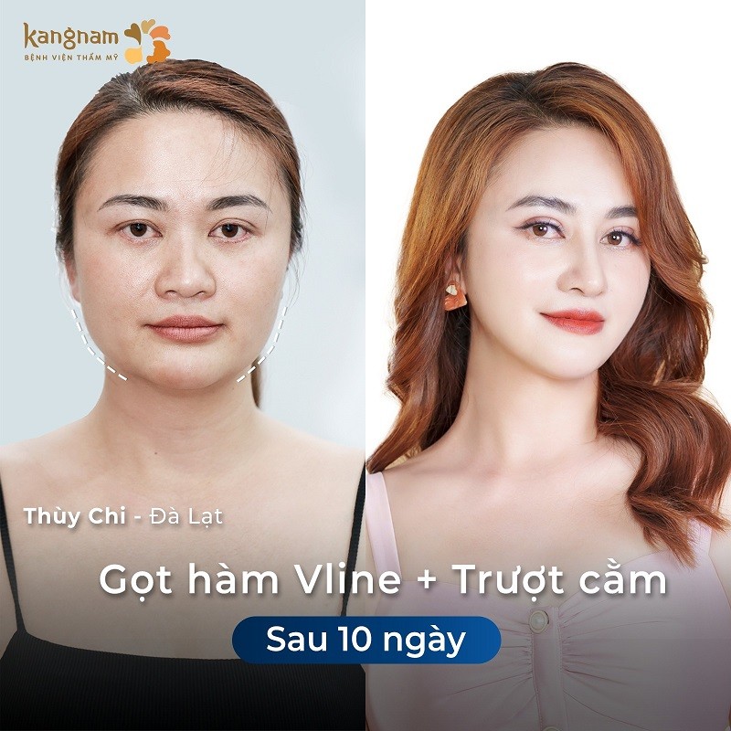 Có thể kết hợp gọt hàm với các phương pháp khác để giúp gương mặt cân đối, thon gọn hơn