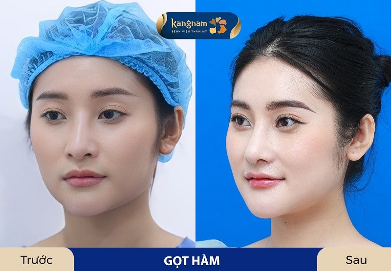 Gọt hàm là can thiệp chỉnh hàm to bạnh
