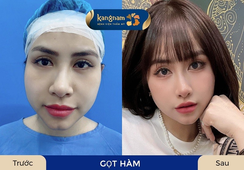 Khách hàng gặp tình trạng gương mặt không cân đối, hàm to bạnh có thể thực hiện gọt hàm