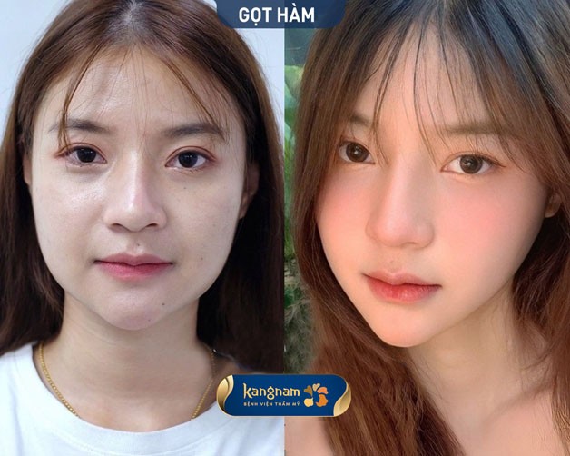 Gọt hàm là phương pháp phẫu thuật thẩm mỹ giúp thay đổi hình dáng cằm và xương hàm