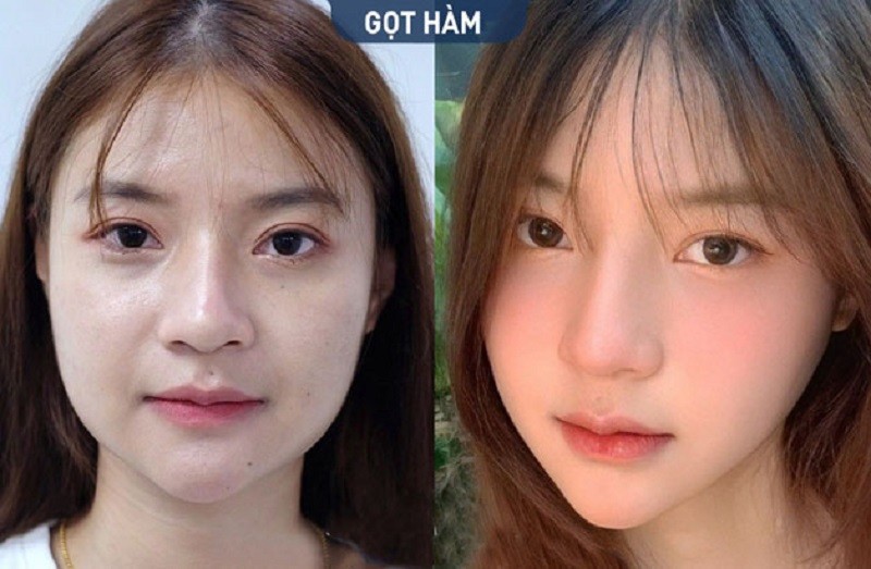 Khi vết thương ổn định, khách hàng có thể đi làm bình thường